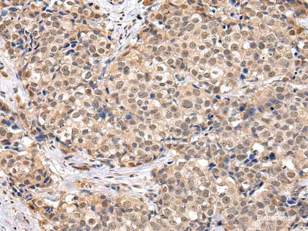 Immunohistochemistry of paraffin-embedded Human breast cancer using TBL1X Polyclonal Antibody at dilution of 1/30