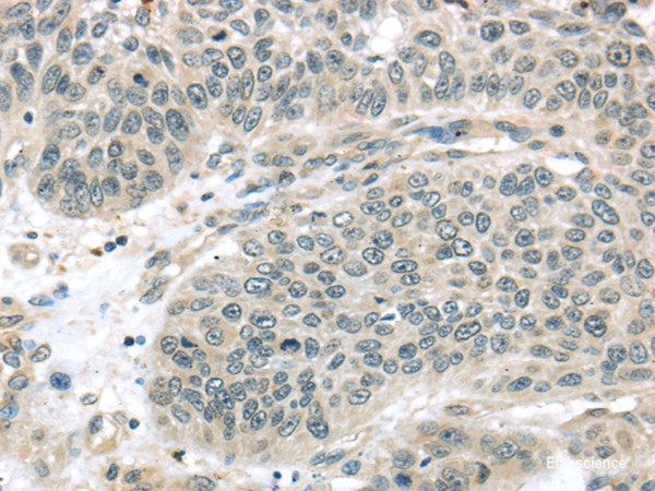 Immunohistochemistry of paraffin-embedded Human lung cancer using THAP4 Polyclonal Antibody at dilution of 1/30
