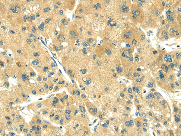 Immunohistochemistry of paraffin-embedded Human liver cancer using TRIM10 Polyclonal Antibody at dilution of 1/35