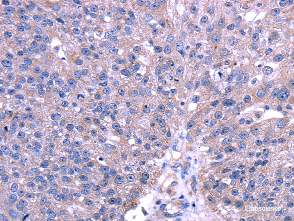 Immunohistochemistry of paraffin-embedded Human breast cancer using TRIM49 Polyclonal Antibody at dilution of 1/40