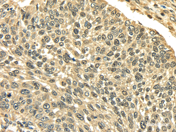 Immunohistochemistry of paraffin-embedded Human lung cancer using PLIN3 Polyclonal Antibody at dilution of 1/35