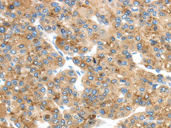 Immunohistochemistry of paraffin-embedded Human liver cancer using TMED4 Polyclonal Antibody at dilution of 1/45