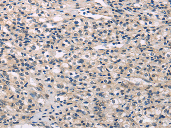 Immunohistochemistry of paraffin-embedded Human prostate cancer using MED28 Polyclonal Antibody at dilution of 1/30