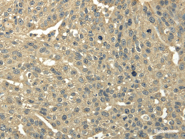 Immunohistochemistry of paraffin-embedded Human breast cancer using TRIB2 Polyclonal Antibody at dilution of 1/30