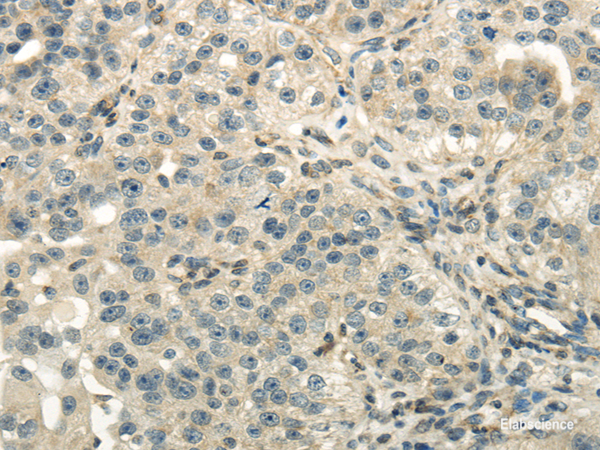 Immunohistochemistry of paraffin-embedded Human breast cancer using DLAT Polyclonal Antibody at dilution of 1/40