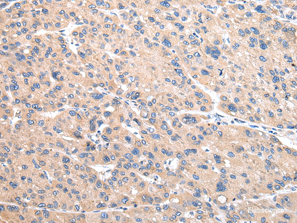 Immunohistochemistry of paraffin-embedded Human liver cancer using VAMP4 Polyclonal Antibody at dilution of 1/30
