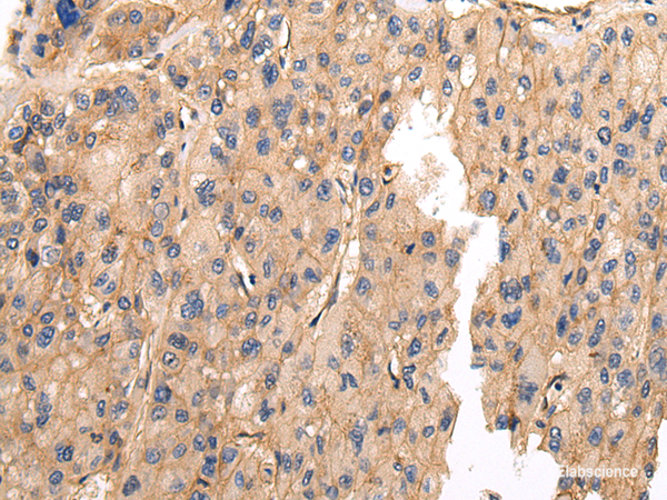 Immunohistochemistry of paraffin-embedded Human liver cancer using VAMP5 Polyclonal Antibody at dilution of 1/25