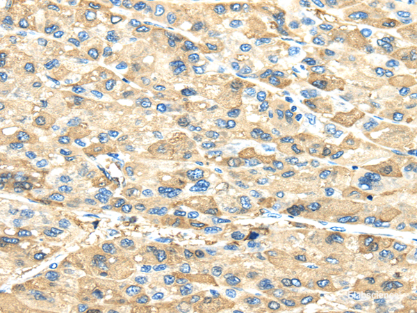 Immunohistochemistry of paraffin-embedded Human liver cancer using INHBB Polyclonal Antibody at dilution of 1/40