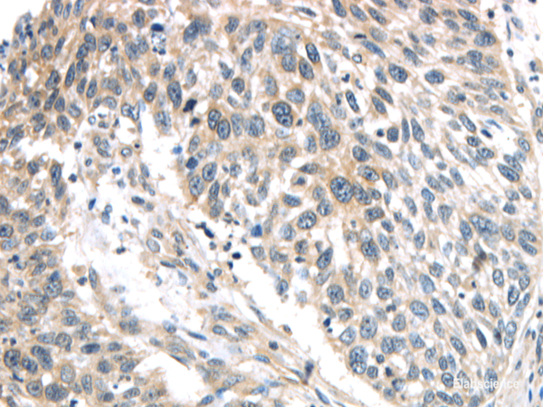 Immunohistochemistry of paraffin-embedded Human lung cancer using IQGAP2 Polyclonal Antibody at dilution of 1/40