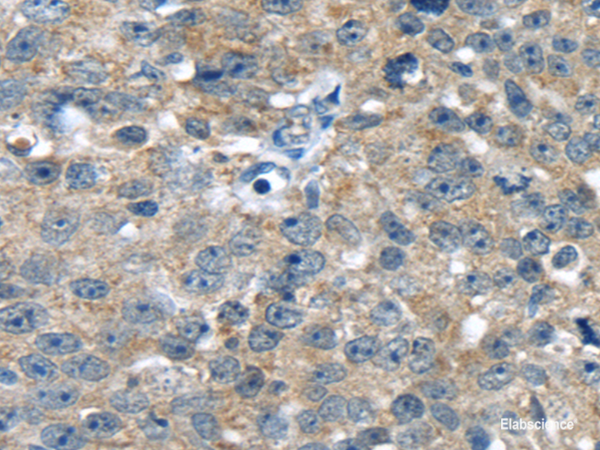 Immunohistochemistry of paraffin-embedded Human breast cancer using PBOV1 Polyclonal Antibody at dilution of 1/20