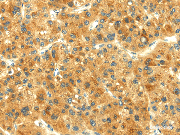 Immunohistochemistry of paraffin-embedded Human liver cancer using THAP3 Polyclonal Antibody at dilution of 1/30