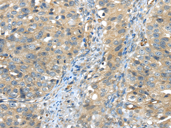 Immunohistochemistry of paraffin-embedded Human breast cancer using ISM2 Polyclonal Antibody at dilution of 1/45