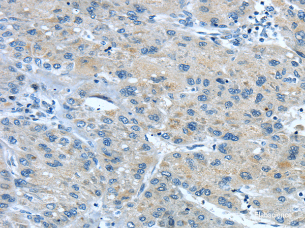 Immunohistochemistry of paraffin-embedded Human liver cancer using TNIP1 Polyclonal Antibody at dilution of 1/35