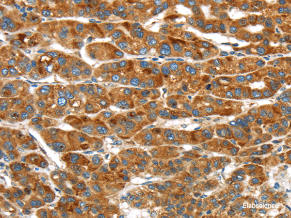 Immunohistochemistry of paraffin-embedded Human liver cancer using ERP44 Polyclonal Antibody at dilution of 1/20