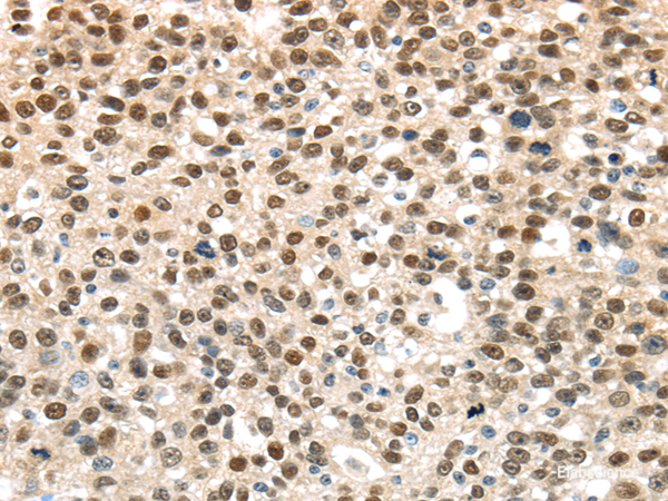 Immunohistochemistry of paraffin-embedded Human breast cancer using UBA1 Polyclonal Antibody at dilution of 1/40