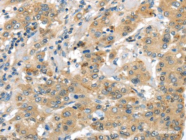 Immunohistochemistry of paraffin-embedded Human liver cancer using UTS2B Polyclonal Antibody at dilution of 1/35
