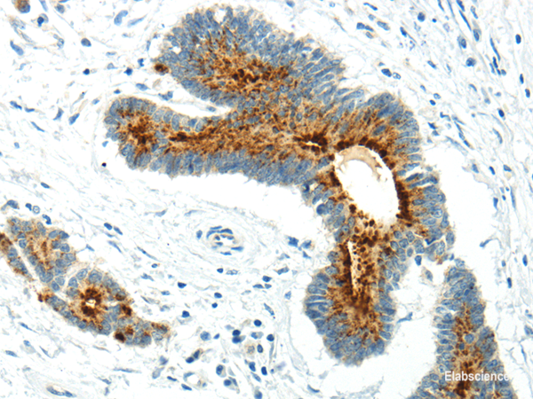 Immunohistochemistry of paraffin-embedded Human colorectal cancer using WWOX Polyclonal Antibody at dilution of 1/20