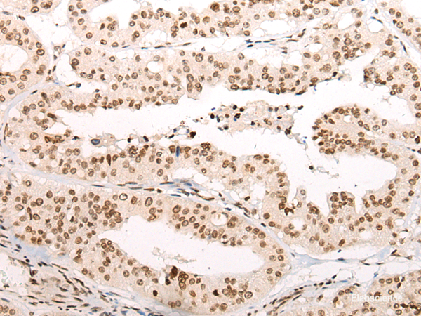 Immunohistochemistry of paraffin-embedded Human liver cancer tissue using VPS51 Polyclonal Antibody at dilution of 1:65(×200)