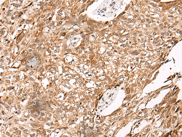 Immunohistochemistry of paraffin-embedded Human lung cancer tissue using C14orf169 Polyclonal Antibody at dilution of 1:45(×200)