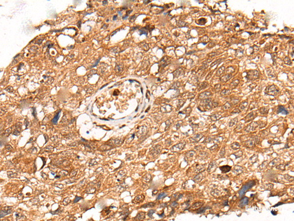 Immunohistochemistry of paraffin-embedded Human lung cancer tissue using KLHL36 Polyclonal Antibody at dilution of 1:55(×200)
