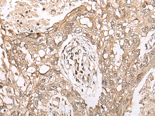 Immunohistochemistry of paraffin-embedded Human lung cancer tissue using M1AP Polyclonal Antibody at dilution of 1:45(×200)