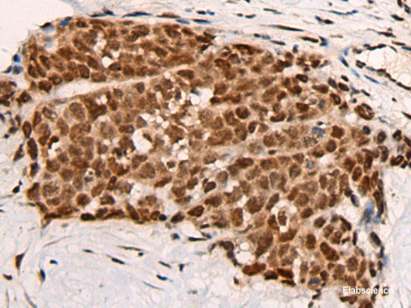 Immunohistochemistry of paraffin-embedded Human thyroid cancer tissue using HGH1 Polyclonal Antibody at dilution of 1:45(×200)