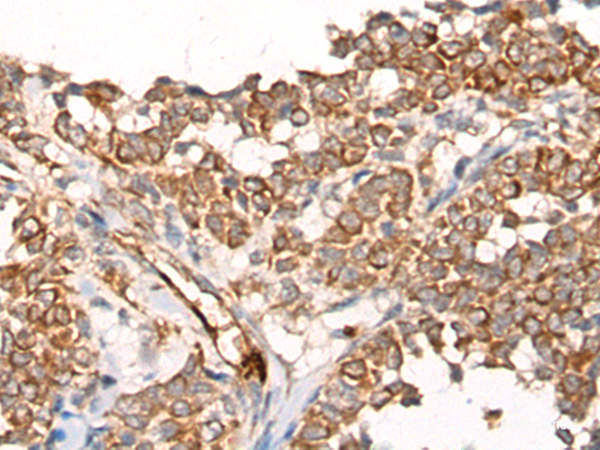 Immunohistochemistry of paraffin-embedded Human ovarian cancer tissue using CA5B Polyclonal Antibody at dilution of 1:65(×200)
