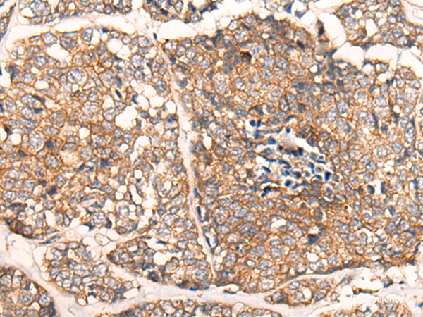 Immunohistochemistry of paraffin-embedded Human esophagus cancer tissue using CACNA2D2 Polyclonal Antibody at dilution of 1:45(×200)