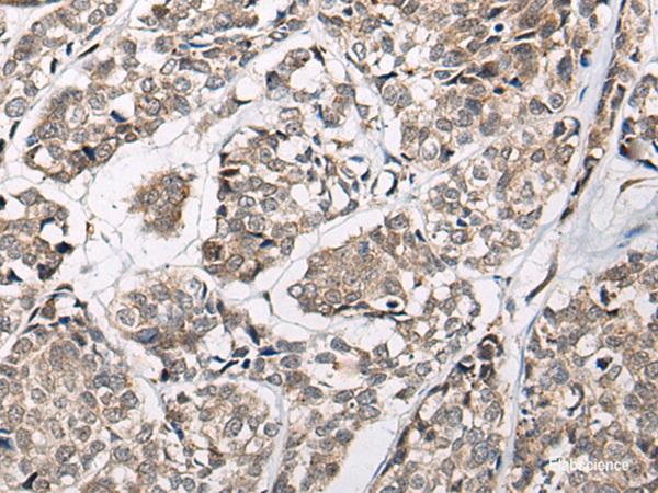 Immunohistochemistry of paraffin-embedded Human esophagus cancer tissue using CACNB3 Polyclonal Antibody at dilution of 1:55(×200)