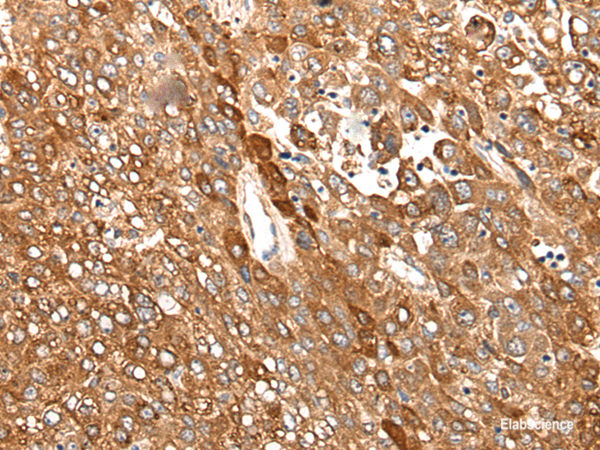 Immunohistochemistry of paraffin-embedded Human liver cancer tissue using CAD Polyclonal Antibody at dilution of 1:50(×200)