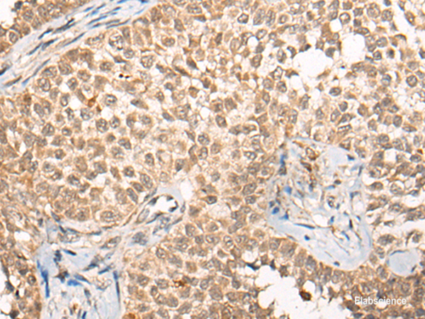 Immunohistochemistry of paraffin-embedded Human ovarian cancer tissue using CABIN1 Polyclonal Antibody at dilution of 1:50(×200)