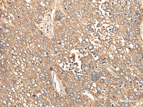Immunohistochemistry of paraffin-embedded Human liver cancer tissue using CALB1 Polyclonal Antibody at dilution of 1:80(×200)