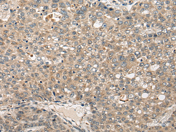 Immunohistochemistry of paraffin-embedded Human liver cancer tissue using FUT4 Polyclonal Antibody at dilution of 1:40(×200)
