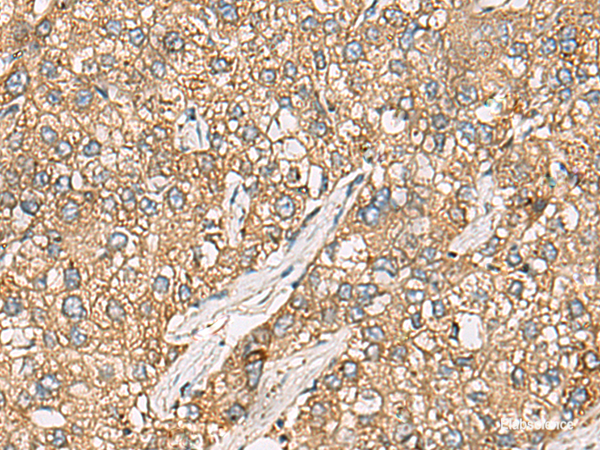 Immunohistochemistry of paraffin-embedded Human liver cancer tissue using CHKA Polyclonal Antibody at dilution of 1:35(×200)