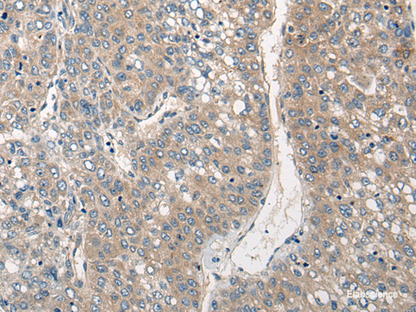 Immunohistochemistry of paraffin-embedded Human liver cancer tissue using CLIC6 Polyclonal Antibody at dilution of 1:40(×200)