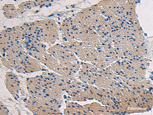 Immunohistochemistry of paraffin-embedded Human gastric cancer tissue using COL17A1 Polyclonal Antibody at dilution of 1:50(×200)