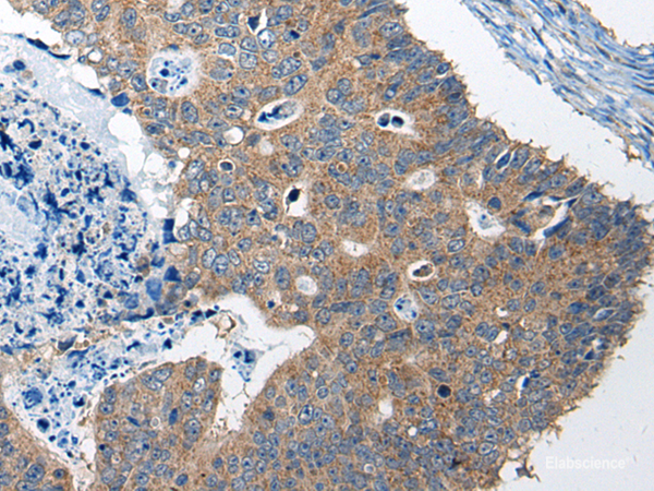 Immunohistochemistry of paraffin-embedded Human colorectal cancer tissue using RTN4IP1 Polyclonal Antibody at dilution of 1:50(×200)