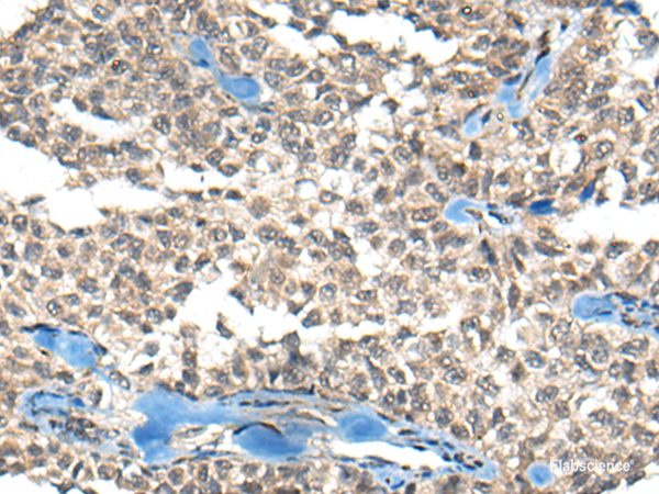 Immunohistochemistry of paraffin-embedded Human ovarian cancer tissue using REST Polyclonal Antibody at dilution of 1:50(×200)