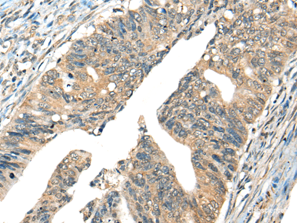 Immunohistochemistry of paraffin-embedded Human colorectal cancer tissue using AIFM2 Polyclonal Antibody at dilution of 1:40(×200)