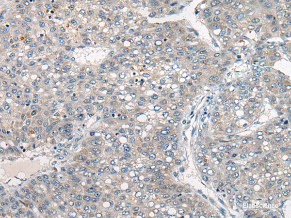 Immunohistochemistry of paraffin-embedded Human liver cancer tissue using DGKI Polyclonal Antibody at dilution of 1:80(×200)