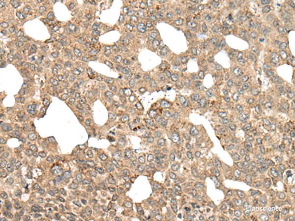 Immunohistochemistry of paraffin-embedded Human liver cancer tissue using APC Polyclonal Antibody at dilution of 1:45(×200)