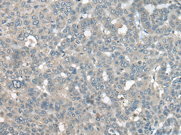 Immunohistochemistry of paraffin-embedded Human liver cancer tissue using UCN3 Polyclonal Antibody at dilution of 1:55(×200)