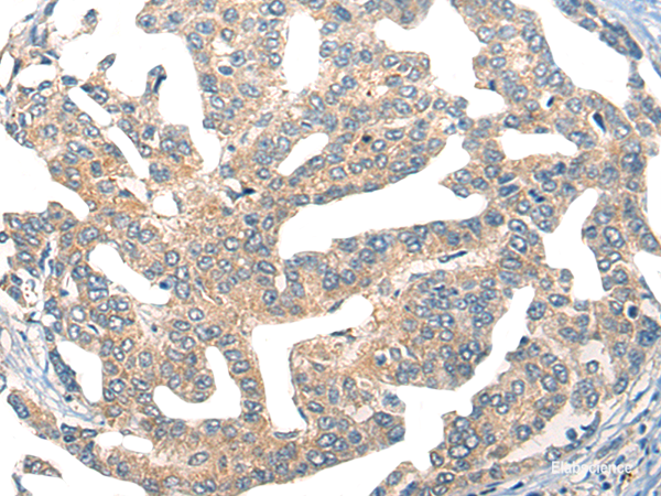Immunohistochemistry of paraffin-embedded Human liver cancer tissue using GPR55 Polyclonal Antibody at dilution of 1:55(×200)