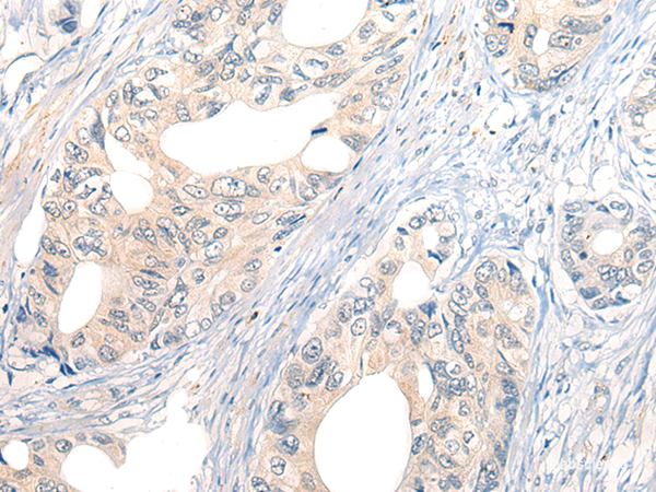 Immunohistochemistry of paraffin-embedded Human gastric cancer tissue using NOG Polyclonal Antibody at dilution of 1:50(×200)