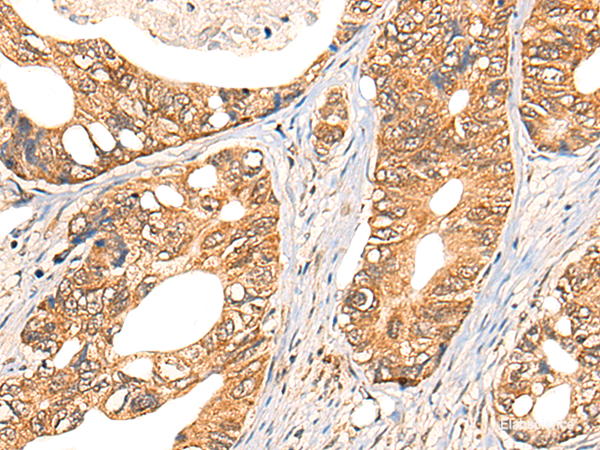 Immunohistochemistry of paraffin-embedded Human gastric cancer tissue using NOL8 Polyclonal Antibody at dilution of 1:40(×200)