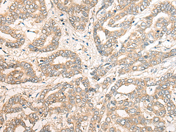 Immunohistochemistry of paraffin-embedded Human liver cancer tissue using PCDHGB5 Polyclonal Antibody at dilution of 1:40(×200)