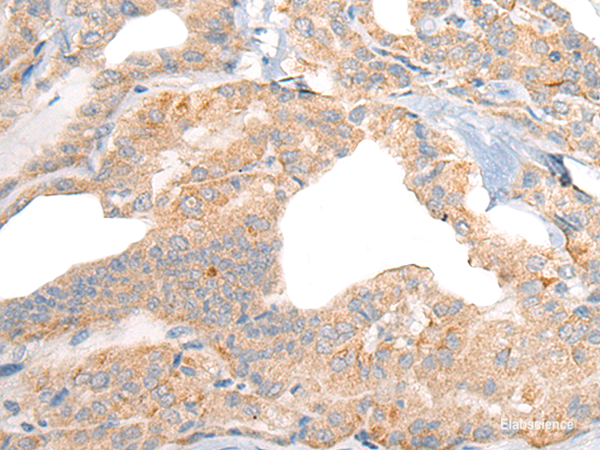 Immunohistochemistry of paraffin-embedded Human thyroid cancer tissue using RGS19 Polyclonal Antibody at dilution of 1:40(×200)