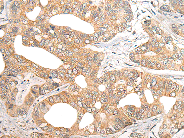 Immunohistochemistry of paraffin-embedded Human gastric cancer tissue using SNX6 Polyclonal Antibody at dilution of 1:40(×200)
