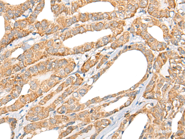 Immunohistochemistry of paraffin-embedded Human thyroid cancer tissue using CCL5 Polyclonal Antibody at dilution of 1:50(×200)
