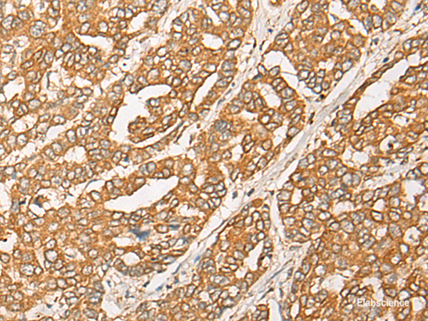 Immunohistochemistry of paraffin-embedded Human liver cancer tissue using GNB1L Polyclonal Antibody at dilution of 1:35(×200)